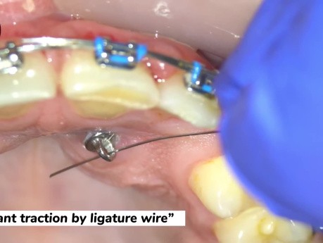 Treatment of Impacted Canine, Step by Step Piggyback Double Wire Mechanics