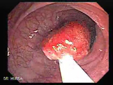 Endoscopic view of Rectal Stalked Polyp (3 of 7)
