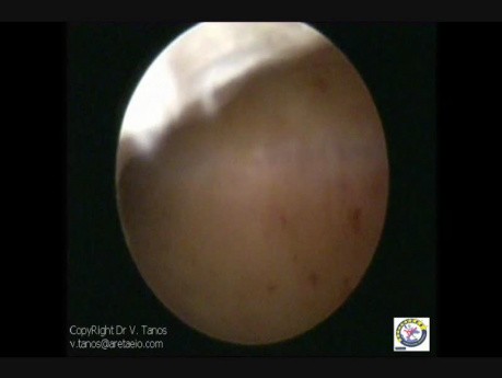 Second Look Hysteroscopy After Resection Of Septum