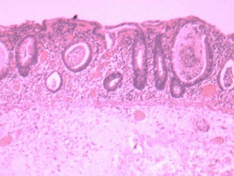 Multiple Rectal Ulcers (103 of 110)