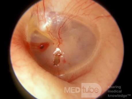 Traumatic Perforation Left Tympanic Membrane