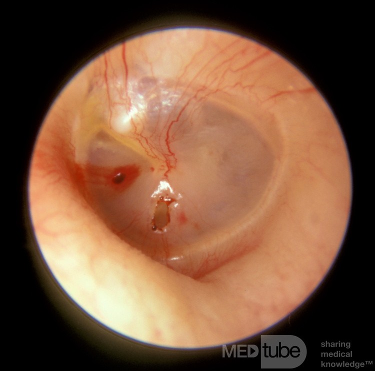 Traumatic Perforation Left Tympanic Membrane
