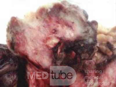 Metastasis of Renal Carcinoma to the ascending colon (11 of 11)