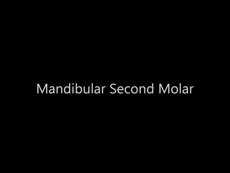 Mandibular Second Molar - Root Canal Anatomy - 2