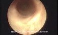 Dumon Stent In The Left Main Bronchus