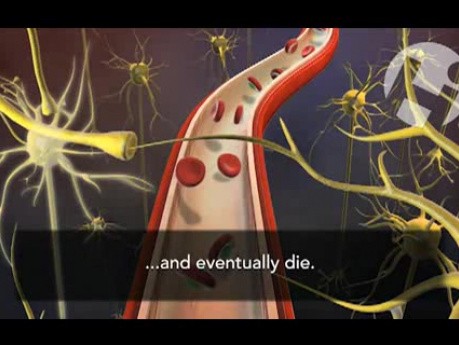 Hypotension and Sickle Cell Anemia