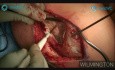 Dega Transiliac Osteotomy - Orthopaedic Live Surgery Broadcast 2019