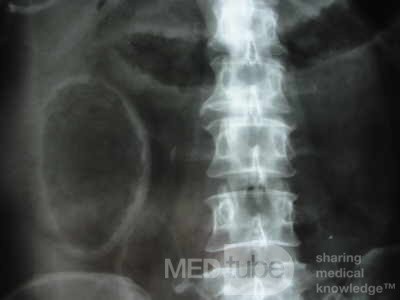 Multiple Rectal Ulcers (36 of 110)