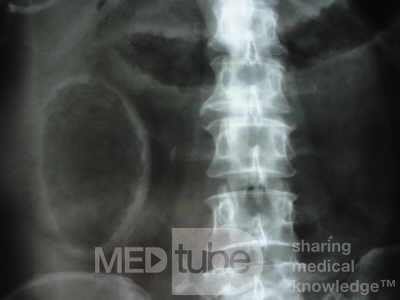 Multiple Rectal Ulcers (36 of 110)