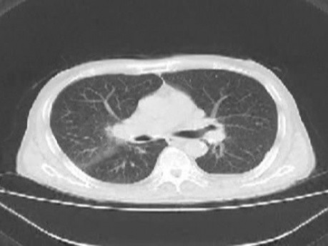 Lung Adenocarcinoma (2 of 5)