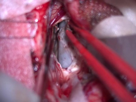 Colloid Cyst. Interhemispheric Transcallosal Approach