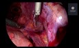 Deep Endometriosis Surgery