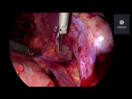 Deep Endometriosis Surgery