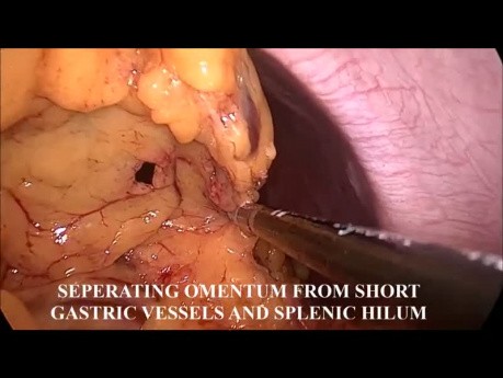 Laparoscopic Total Omentectomy
