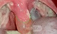 Uvula Oedema Post-Tonsillectomy