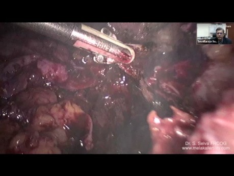 TLH with Large Endometrioma and Severe Endometriosis