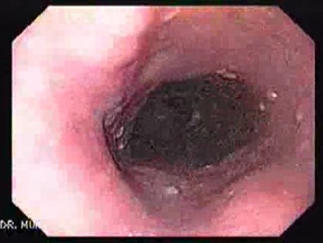 Longstanding gastroesophageal reflux disease -glycogenic acanthosis (2 of 7)