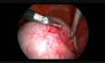 Laparoscopic Large Deromid Cystectomy