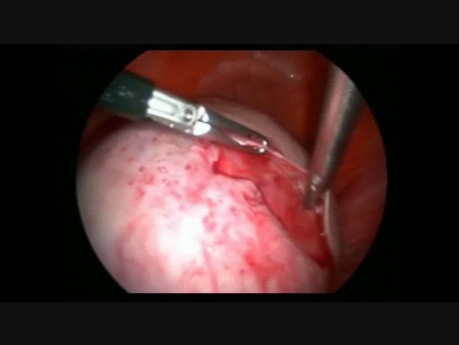 Laparoscopic Large Deromid Cystectomy