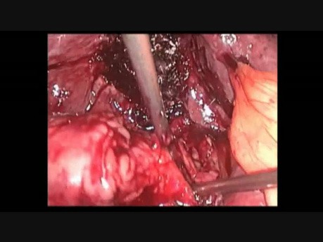 Clipless Minilaparoscopic Cholecystectomy - Tips&Tricks