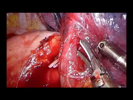 Uniportal VATS Left Apico-Posterior Anatomic Segmentectomy (S1-2)
