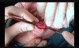 Upper Lid Blepharoplasty
