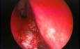 Nasal Septal Spur - Endoscopic Removal