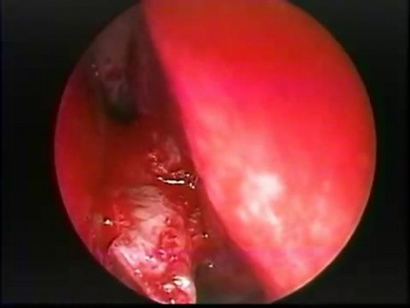 Nasal Septal Spur - Endoscopic Removal