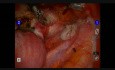 20 Week Size Robotic Hysterectomy