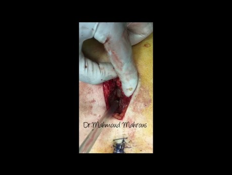 Subxiphoid Pericardiostomy