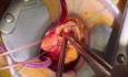 Limited Thoracotomy Aortic Valve Replacement
