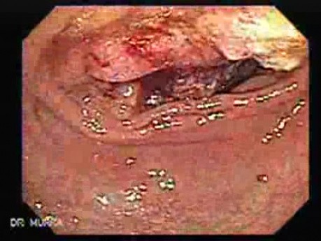 Rectum Adenocarcinoma (4 of 4)