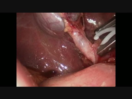 Laparoscopic Radical Cholecystectomy 