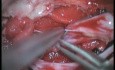 Sacral Meningeal Cysts - Posterior Approach