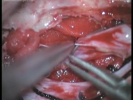 Sacral Meningeal Cysts - Posterior Approach