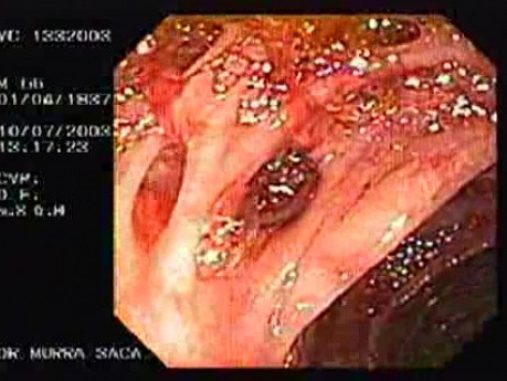 Diverticular Bleeding (1 of 4)