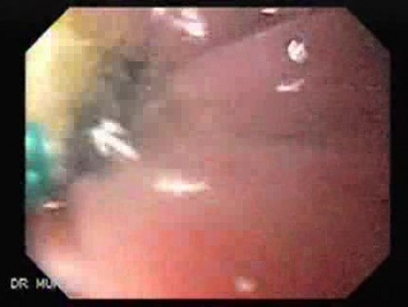 Esophageal Stricture After Total Gastrectomy And Chemoradiation - Baloon Dilation - 3/6