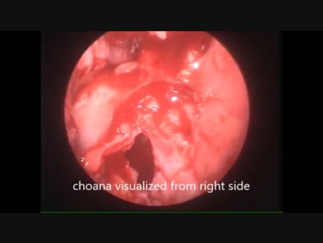 Endoscopic Choanal Atresia Repair