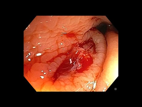 Rectal Polypectomy With Cold Snare