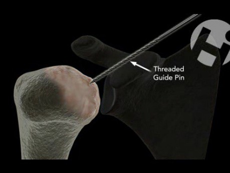 Humeral Head Resurfacing