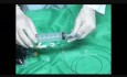 Intragastric Balloon Implant