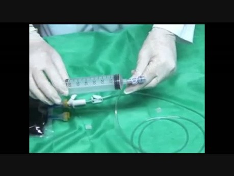 Intragastric Balloon Implant