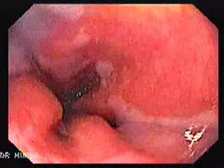 Barrett Esophagus -GERD- (1 of 6)