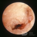 Squamous Cell Carcinoma of the External Auditory Canal