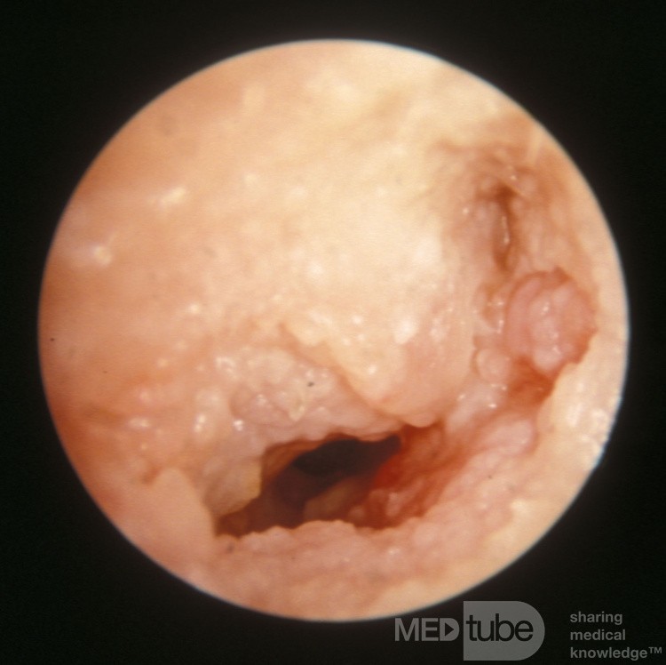 Squamous Cell Carcinoma of the External Auditory Canal