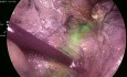 Total Laparoscopic Hysterectomy (TLH) - ICG