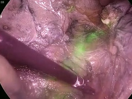 Total Laparoscopic Hysterectomy (TLH) - ICG