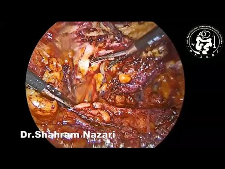 TAR Hernioraphy