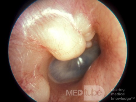 Large Exostosis
