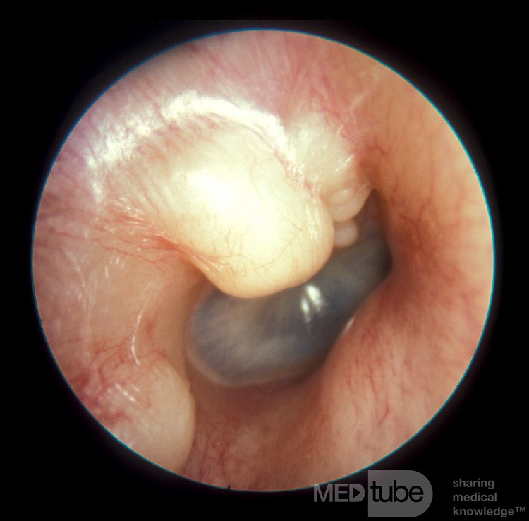Large Exostosis